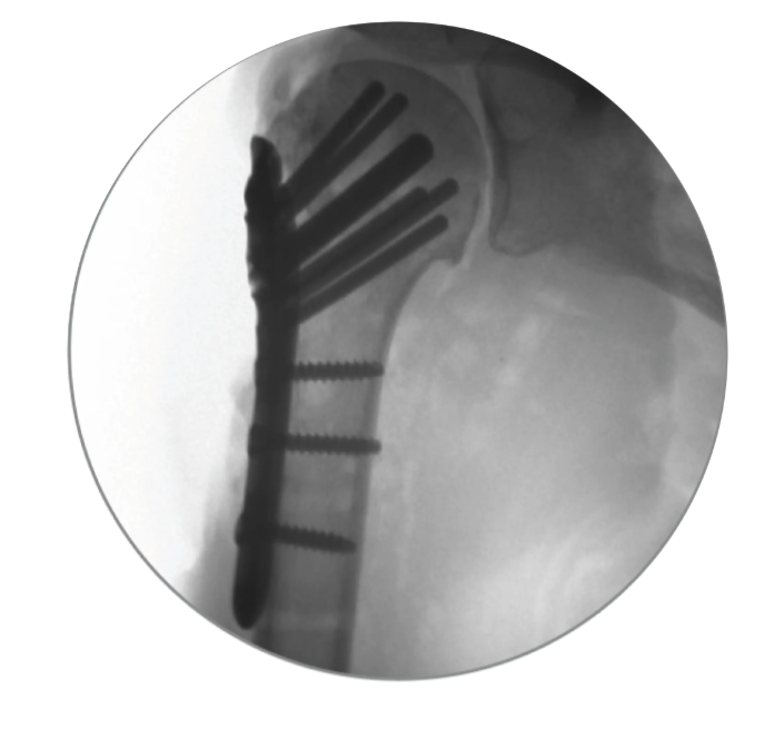 Shoulder fixation radiograph